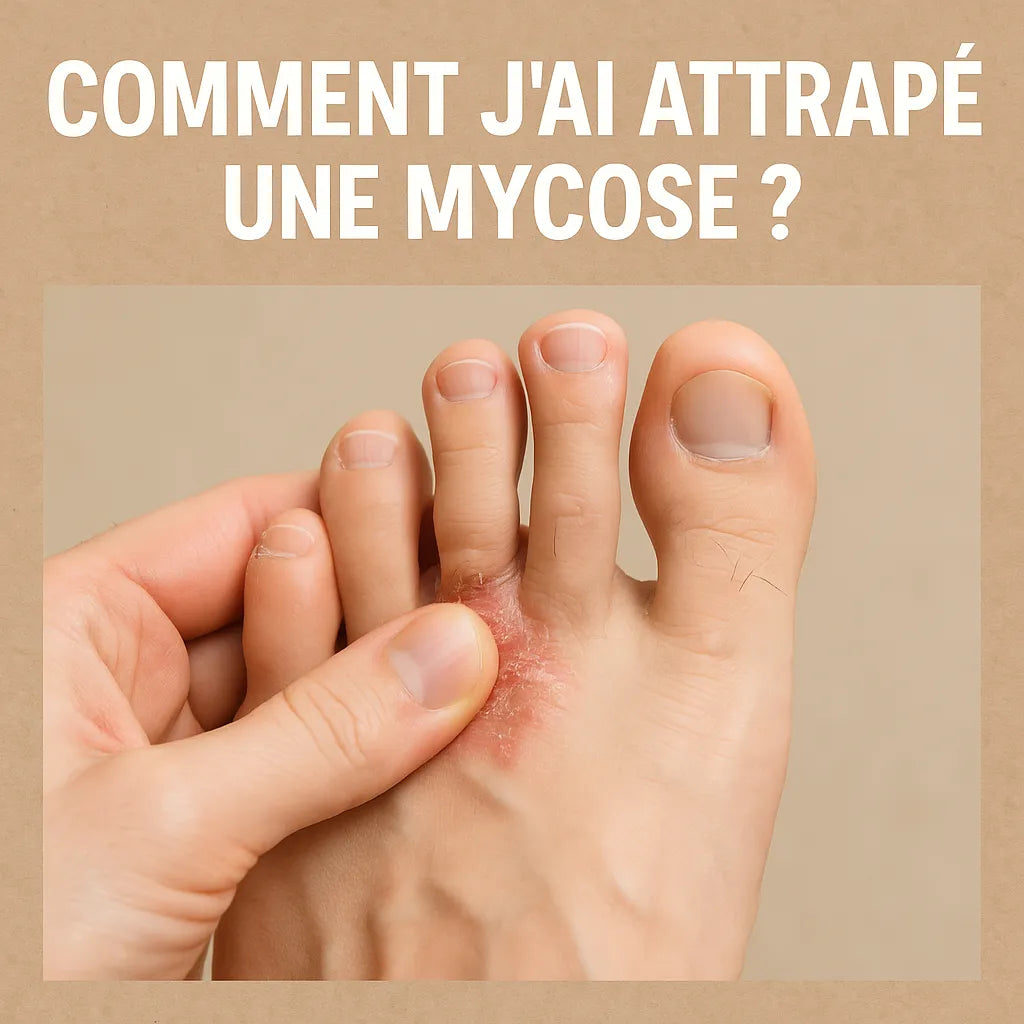 Comment J'Ai Attrapé Une Mycose ?