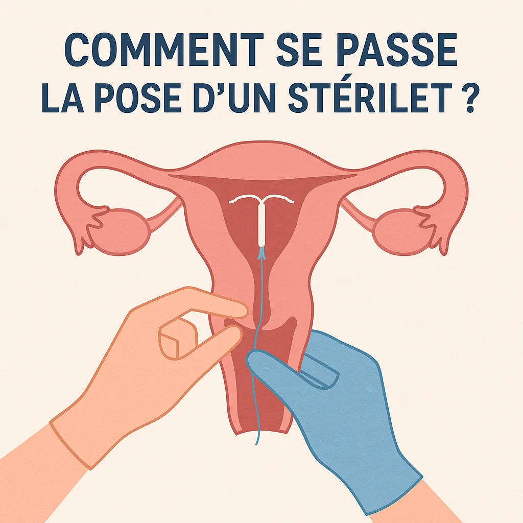 Comment Se Passe La Pose D'Un Stérilet ?
